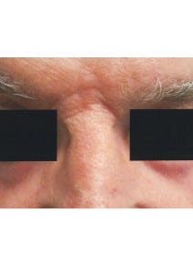 CO2 Laser Resurfacing after photo, close-up view (case 9073)