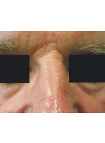 CO2 Laser Resurfacing before photo, close-up view (case 9073)