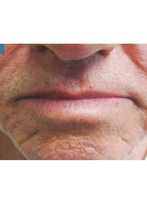 CO2 Laser Resurfacing after photo, close-up view (case 9076)