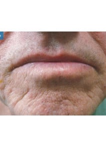 CO2 Laser Resurfacing before photo, close-up view (case 9076)