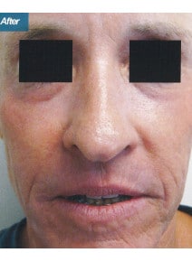 CO2 Laser Resurfacing after photo, front view (case 9079)