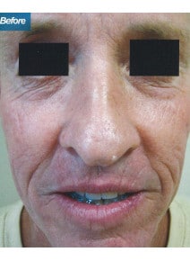 CO2 Laser Resurfacing before photo, front view (case 9079)