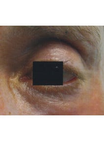 CO2 Laser Resurfacing after photo, close-up view (case 9082)