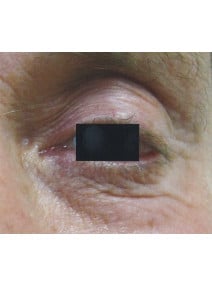 CO2 Laser Resurfacing before photo, close-up view (case 9082)