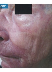 CO2 Laser Resurfacing after photo, oblique left view (case 9085)