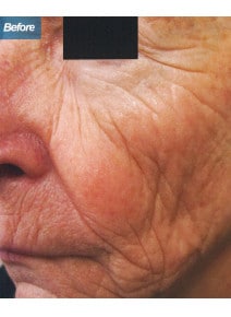 CO2 Laser Resurfacing before photo, oblique left view (case 9085)