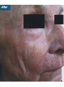 CO2 Laser Resurfacing after photo, oblique right view (case 9085)
