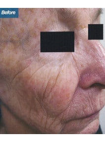 CO2 Laser Resurfacing before photo, oblique right view (case 9085)