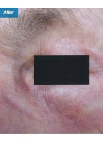 CO2 Laser Resurfacing after photo, close-up view (case 9085)