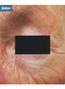 CO2 Laser Resurfacing before photo, close-up view (case 9085)