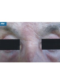 CO2 Laser Resurfacing after photo, close-up view (case 9090)