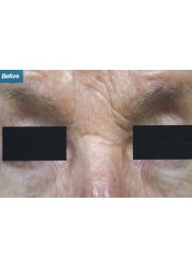 CO2 Laser Resurfacing before photo, close-up view (case 9090)