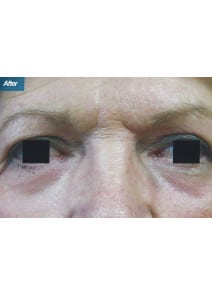 CO2 Laser Resurfacing after photo, close-up view (case 9093)
