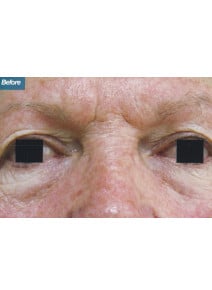 CO2 Laser Resurfacing before photo, close-up view (case 9093)