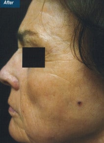 CO2 Laser Resurfacing after photo, left view (case 9096)
