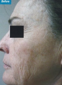 CO2 Laser Resurfacing before photo, left view (case 9096)