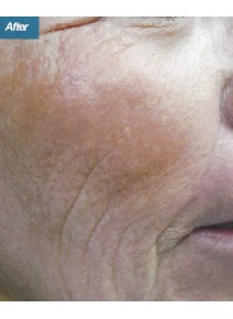 CO2 Laser Resurfacing after photo, right view (case 9099)