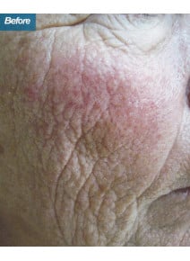 CO2 Laser Resurfacing before photo, right view (case 9099)