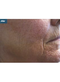 CO2 Laser Resurfacing after photo, close-up view (case 9102)