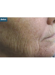 CO2 Laser Resurfacing before photo, close-up view (case 9102)