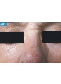 CO2 Laser Resurfacing after photo, close-up view (case 9105)