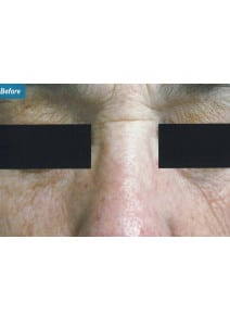 CO2 Laser Resurfacing before photo, close-up view (case 9105)