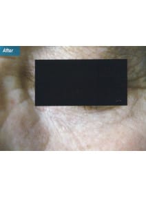 CO2 Laser Resurfacing after photo, close-up view (case 9105)