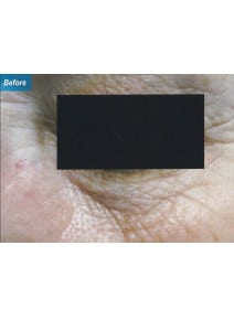 CO2 Laser Resurfacing before photo, close-up view (case 9105)
