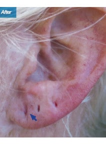 Earlobe Filler after photo, close-up view (case 9112)