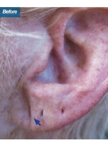 Earlobe Filler before photo, close-up view (case 9112)