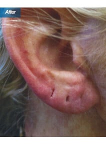 Earlobe Filler after photo, close-up view (case 9113)