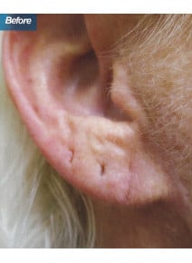 Earlobe Filler before photo, close-up view (case 9113)