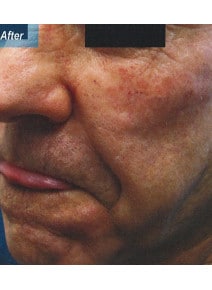 Laugh Lines and Under Eyes after photo, oblique left view (case 9118)