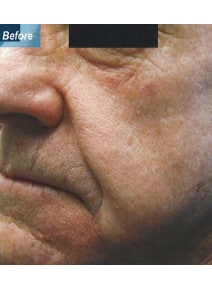 Laugh Lines and Under Eyes before photo, oblique left view (case 9118)