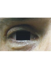 Eyelid Surgery after photo, left view (case 9129)