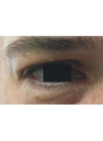 Eyelid Surgery before photo, left view (case 9129)