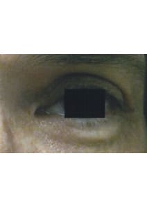 Eyelid Surgery after photo, right view (case 9129)