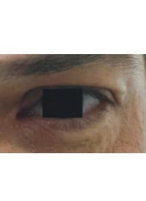 Eyelid Surgery before photo, right view (case 9129)