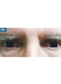 Eyelid Surgery after photo, close-up view (case 9133)