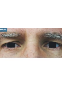 Eyelid Surgery before photo, close-up view (case 9133)