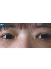 Eyelid Surgery after photo, close-up view (case 9136)