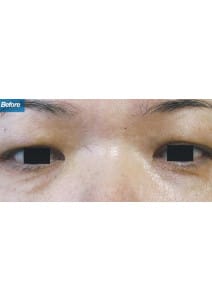 Eyelid Surgery before photo, close-up view (case 9136)