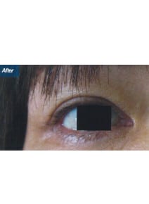 Eyelid Surgery after photo, left view (case 9136)