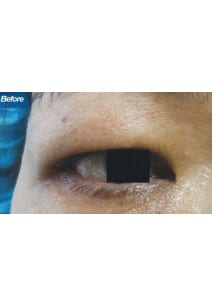 Eyelid Surgery before photo, left view (case 9136)