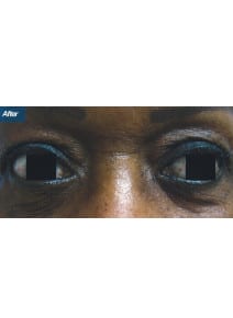 Lower Eyelid Surgery after photo, close-up view (case 9140)