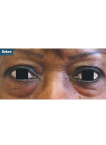 Lower Eyelid Surgery before photo, close-up view (case 9140)
