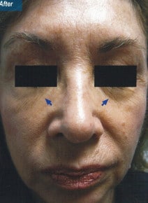 Under Eyes after photo, front view (case 9143)