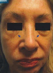 Under Eyes before photo, front view (case 9143)