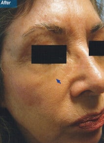 Under Eyes after photo, oblique right view (case 9143)