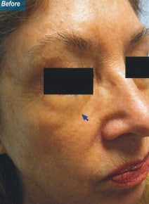 Under Eyes before photo, oblique right view (case 9143)